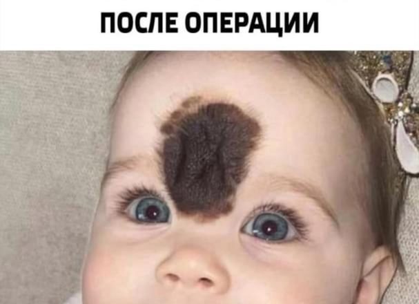 Удалили родимое пятно на пол лица. Мама особенной девочки показала, как выглядит подросшая дочь после опеpации
