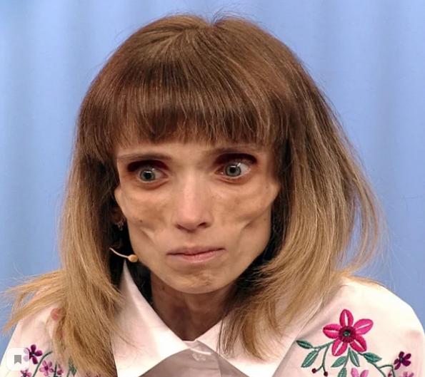 Как сложилась жизнь Кристины из передачи «Пусть говорят», весившей 17 килограмм