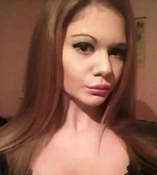 «Они же лопнут!»: девушка вколола 27 филлеров в губы. Как она выглядела до преображения?