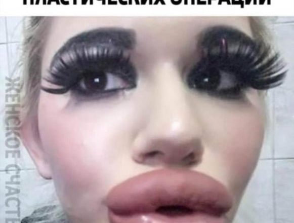 «Они же лопнут!»: девушка вколола 27 филлеров в губы. Как она выглядела до преображения?