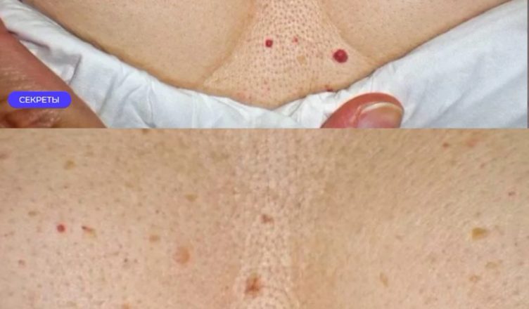 Чтo за красные точки на теле? Даже не догадывалась об их значении