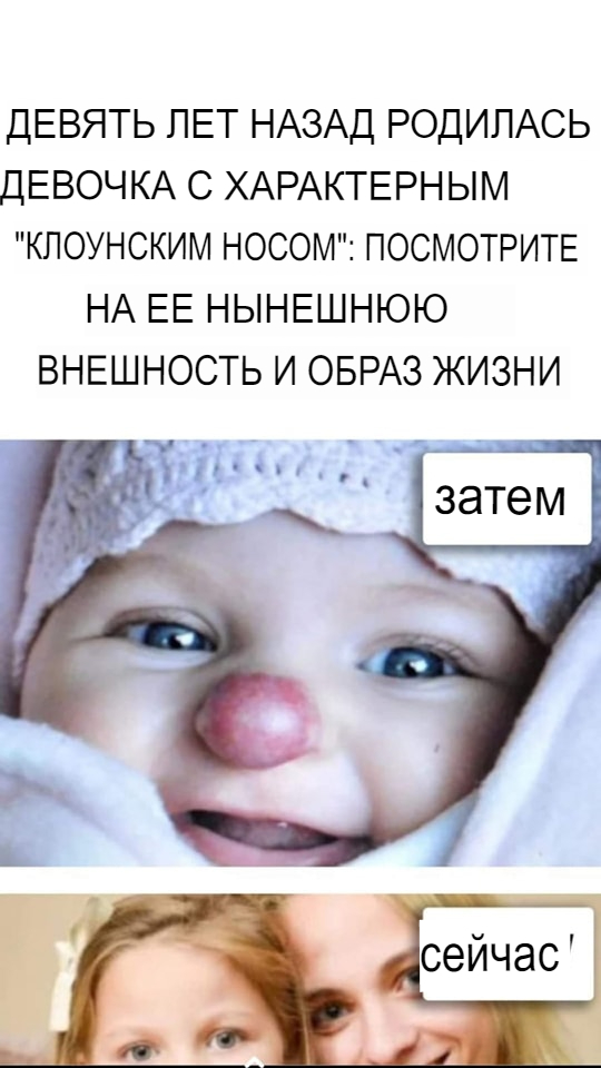 Девять лет назад родилась девочка с характерным «носом клоуна»: посмотрите на ее нынешнюю внешность и образ жизни