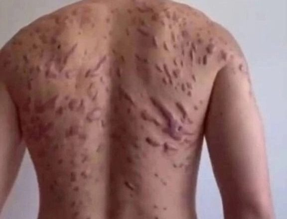Как избавиться от прыщей на спине