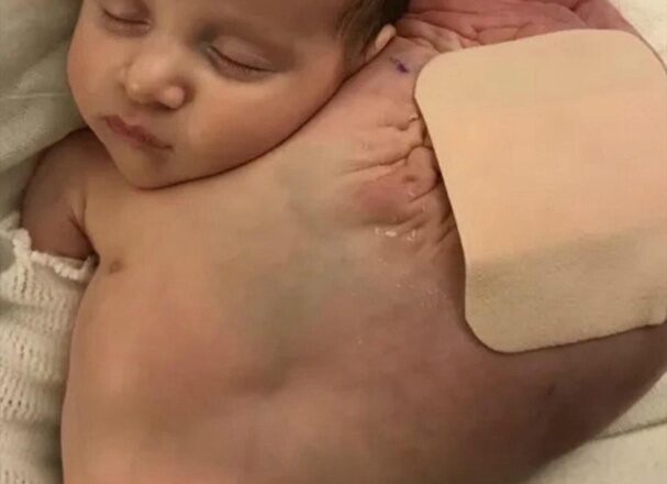 Мой сын родился с кистой размером с футбольный мяч под мышкой