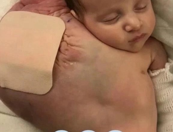 Мой сын родился с кистой размером с футбольный мяч под мышкой
