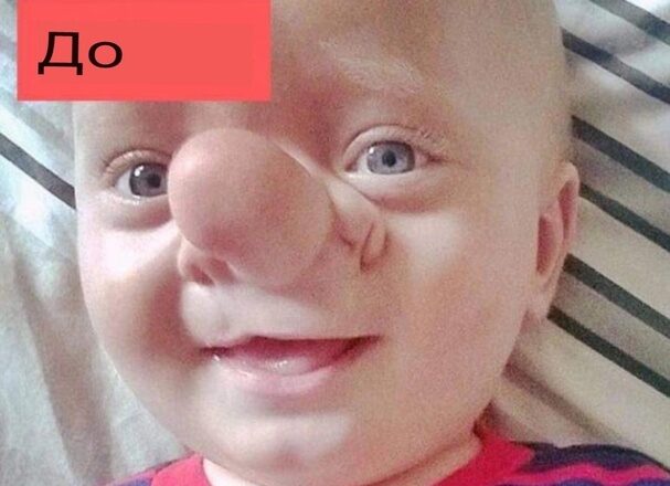 Этого малыша прозвали Пиноккио, и посмотрите, как он выглядит спустя годы…