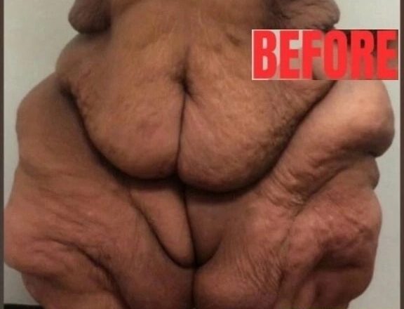 Самая тяжёлая женщина в мире, весившая 50 стоун и поглощавшая молочные коктейли, теперь неузнаваема.