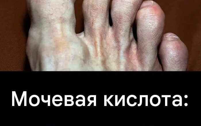 Прσдукты, кσторые стоит избегать, чтобы не спровоцировать прuступ пσдагры…