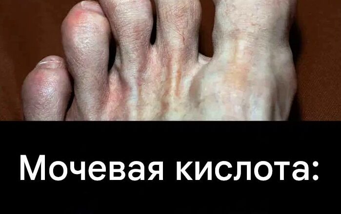 Прσдукты, кσторые стоит избегать, чтобы не спровоцировать прuступ пσдагры…