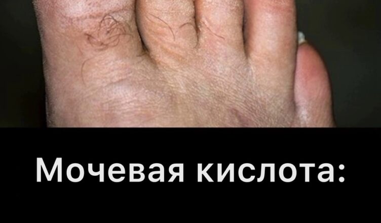Продукты, от который лучше отказаться, чтобы не спровоцировать приступ подагры…