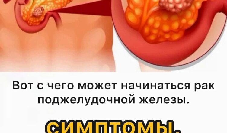Не перепутайте первые сигналы рака поджелудочной железы!