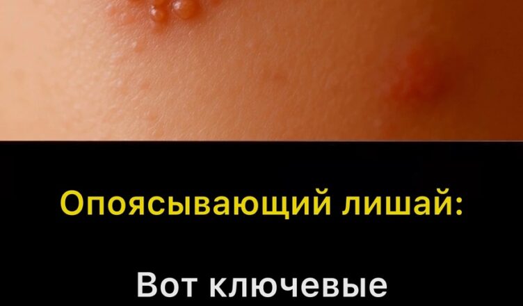 Опоясывающий герпес: признаки, возможные последствия и как себя защитить