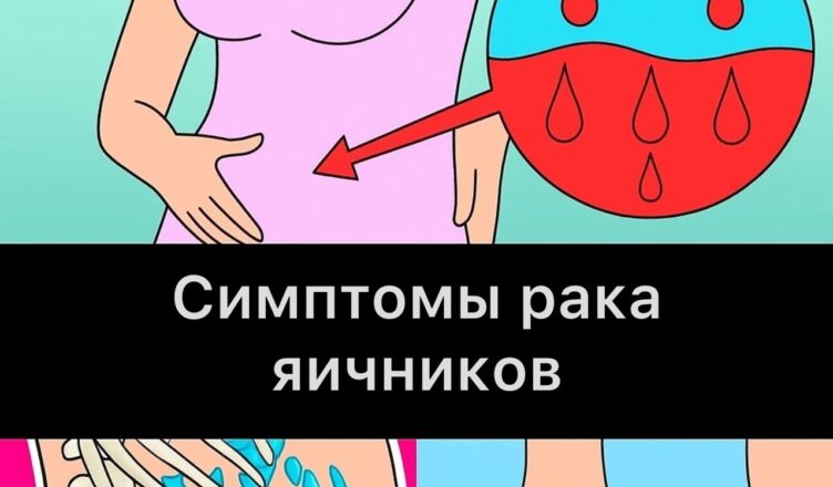 Признаки рака яичников…