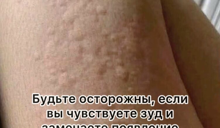 Почему на коже возникает крапивница? Неожиданные причины, о которых вы могли не догадываться.