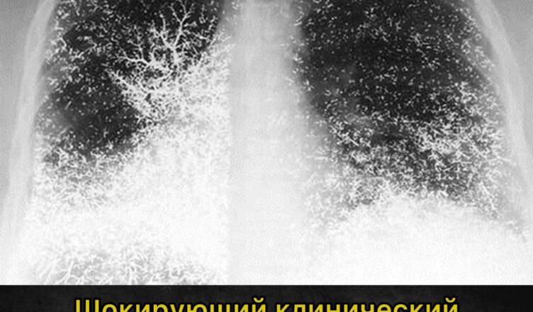 21-летняя девушка ввела себе ртуть прямо в вену…