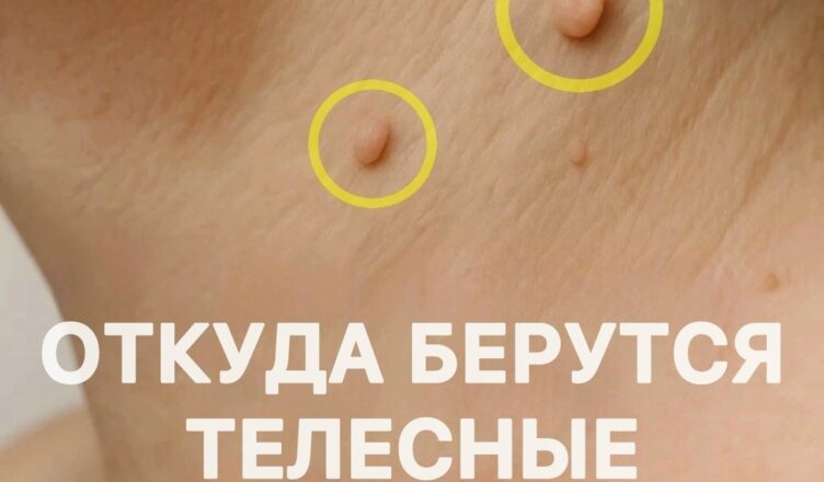 Папилломы на шее и в подмышках нередко принимают за обычные родинки.