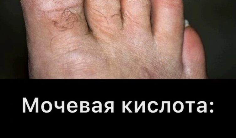 Продукты, от который лучше отказаться, чтобы не спровоцировать приступ подагры…