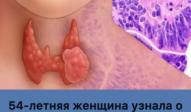 54-летняя женщина выявила рак щитовидной железы по признаку, который часто остаётся без внимания