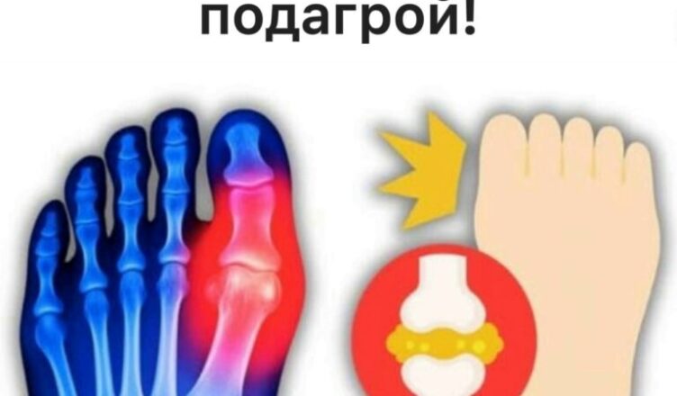 Топ-5 напитков, которые помогают снизить уровень мочевой кислоты и облегчить подагру.