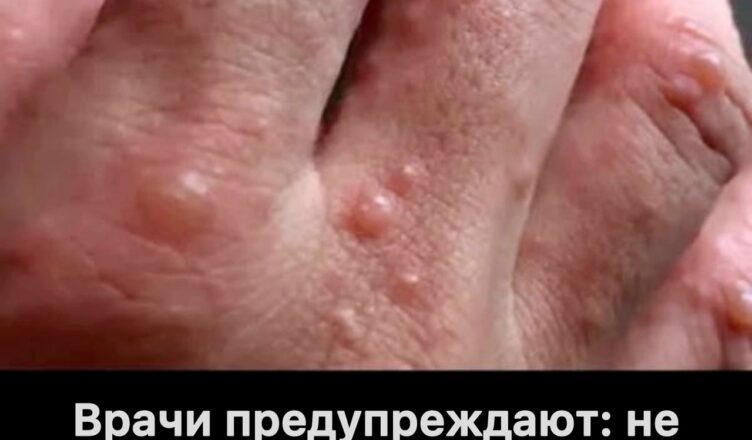 Врачи предупреждают: появление мелких красных точек на руке или кисти — тревожный сигнал, который нельзя игнорировать