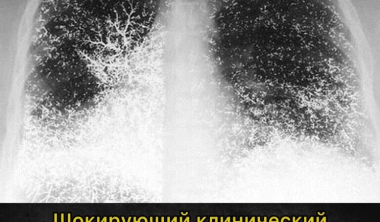 21-летняя девушка ввела себе ртуть прямо в вену…