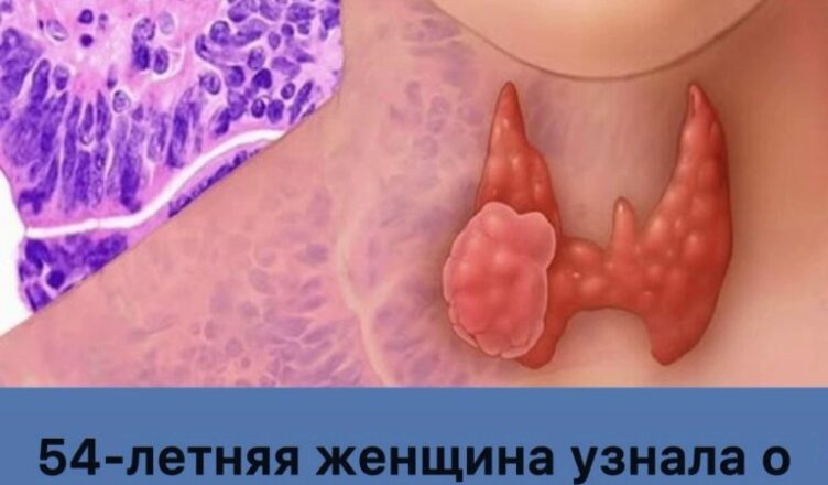 54-летняя женщина выявила рак щитовидной железы по признаку, который часто остаётся без внимания