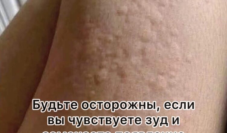 Почему на коже возникает крапивница? Неожиданные причины, о которых вы могли не догадываться.