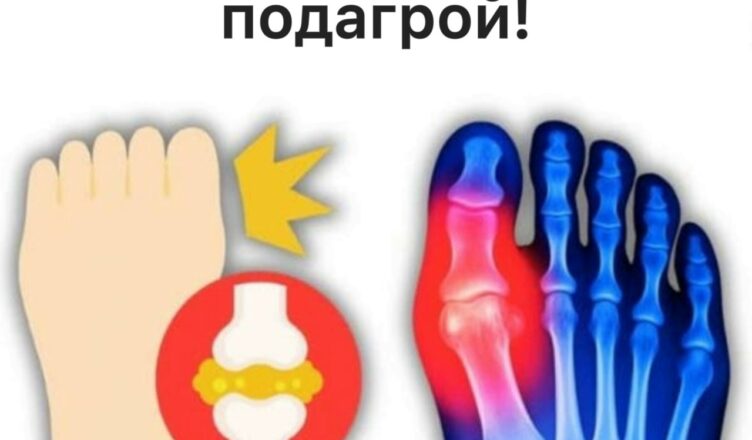 Топ-5 напитков, которые помогают снизить уровень мочевой кислоты и облегчить подагру.