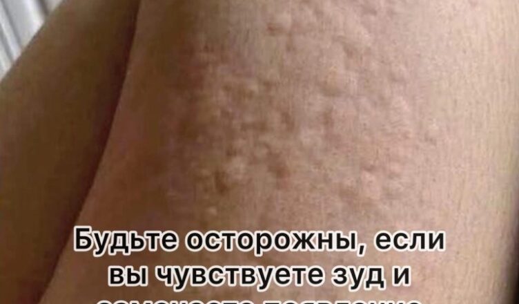 Почему на коже возникает крапивница? Неожиданные причины, о которых вы могли не догадываться.